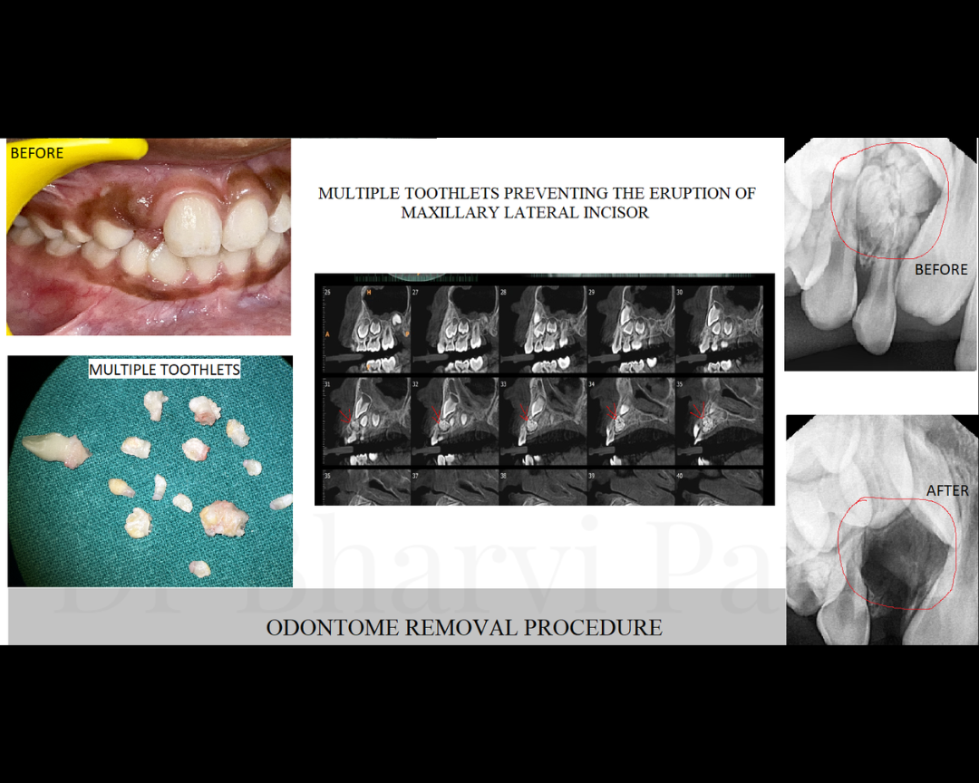What looks like a tooth but isn't ? .  An odontoma and removing it can transform a patient's entire dental development.