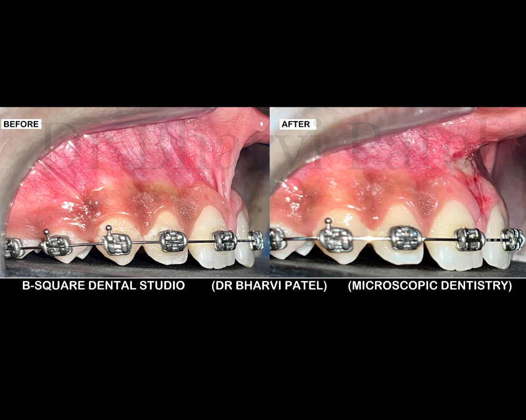 Small tissue .big impact. Frenectomy " THE PROCEDURE THAT FREES YOUR SMILE AND YOUR SPEECH. "