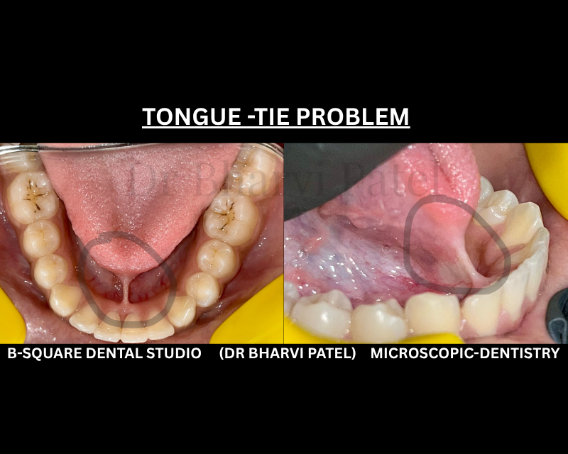 Tongue tie isn't just a baby problem. Adult live with it undiagnosed their whole live .